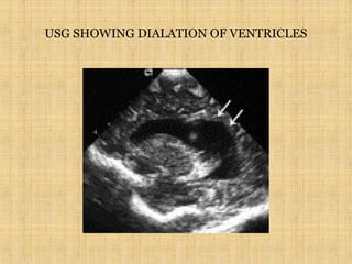 USG SHOWING DIALATION OF VENTRICLES
 
