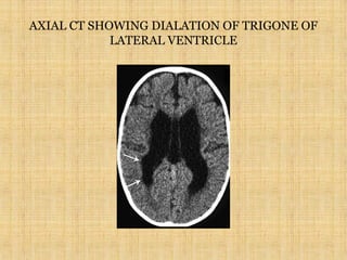 AXIAL CT SHOWING DIALATION OF TRIGONE OF
LATERAL VENTRICLE
 