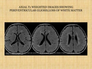 AXIAL T1 WEIGHTED IMAGES SHOWING
PERIVENTRICULAR GLIOSIS,LOSS OF WHITE MATTER
 