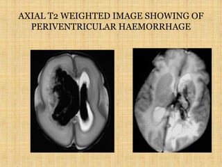 AXIAL T2 WEIGHTED IMAGE SHOWING OF
PERIVENTRICULAR HAEMORRHAGE
 