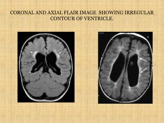 CORONAL AND AXIAL FLAIR IMAGE SHOWING IRREGULAR
CONTOUR OF VENTRICLE.
 