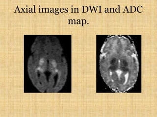 Axial images in DWI and ADC
map.
 