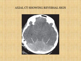 AXIAL CT SHOWING REVERSAL SIGN
 