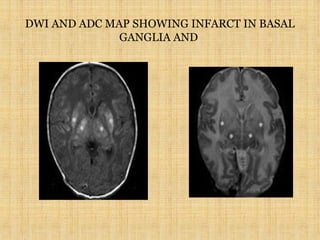 DWI AND ADC MAP SHOWING INFARCT IN BASAL
GANGLIA AND
 