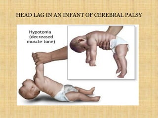 HEAD LAG IN AN INFANT OF CEREBRAL PALSY
 