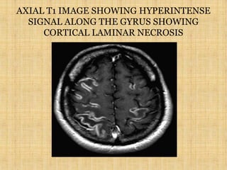 AXIAL T1 IMAGE SHOWING HYPERINTENSE
SIGNAL ALONG THE GYRUS SHOWING
CORTICAL LAMINAR NECROSIS
 
