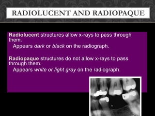 Are Rocks Radiopaque radiographs basics | PPTX