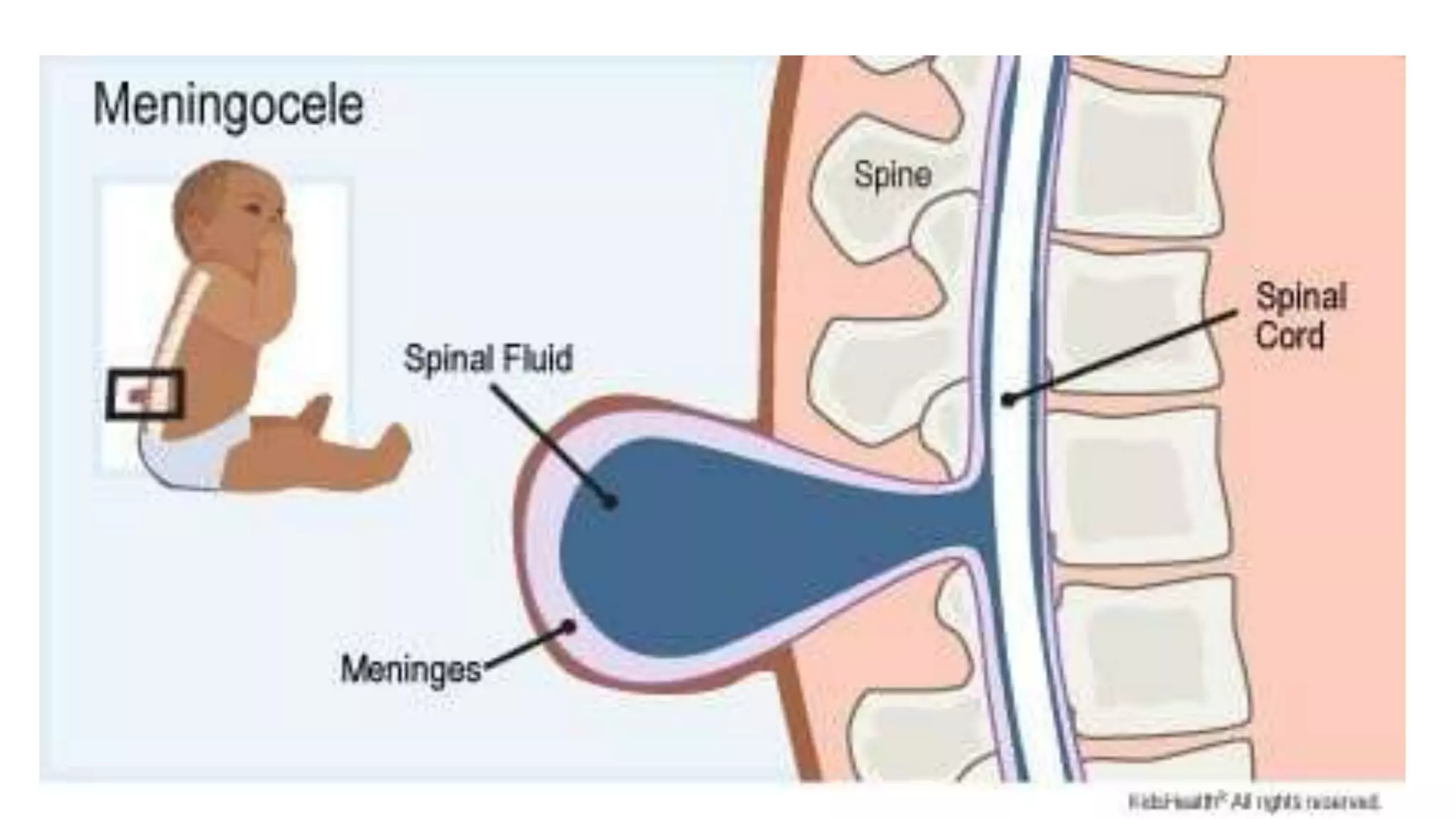 Netural Defect neural tube defect.pptx