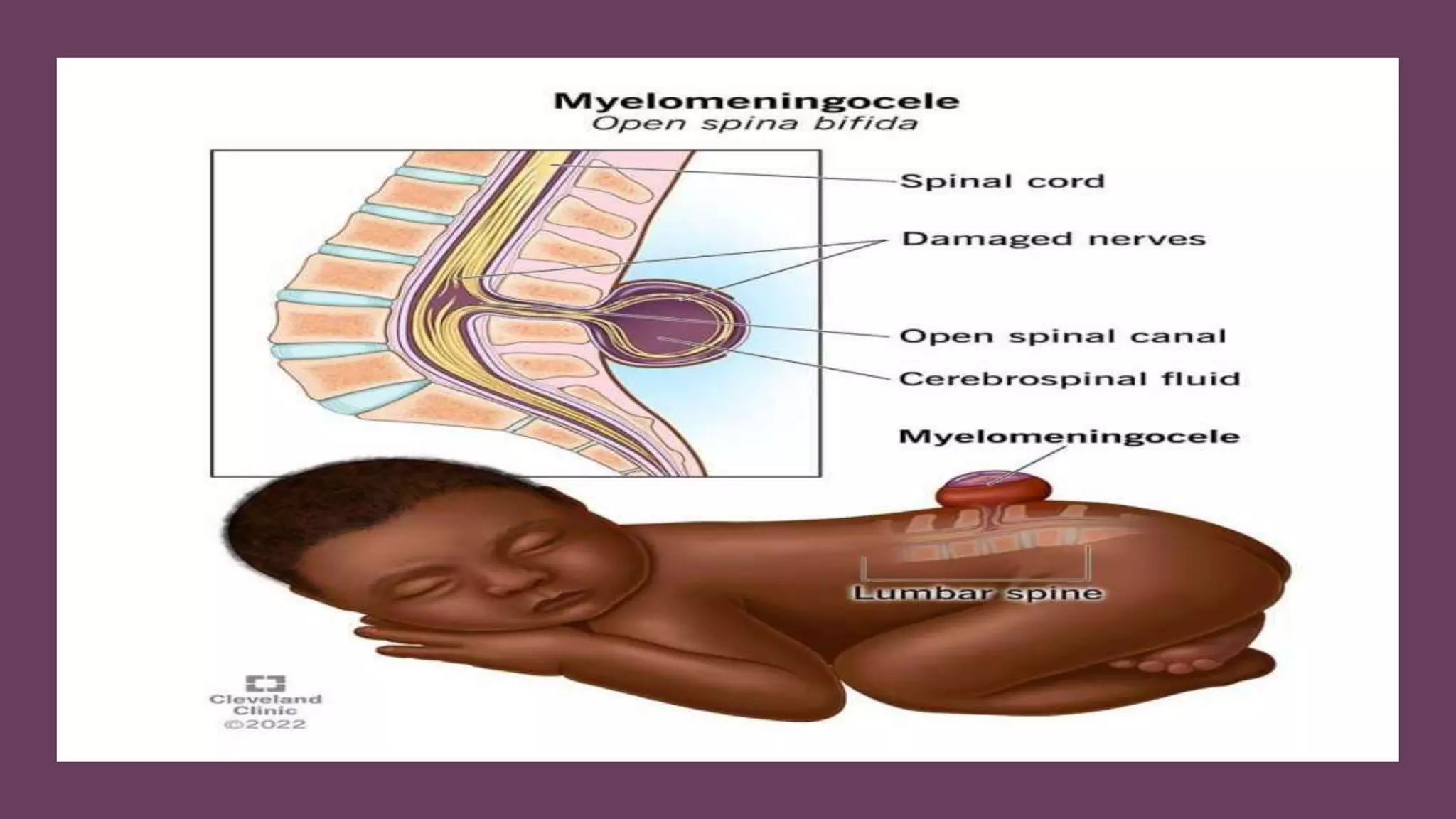 neural tube defect.pptx