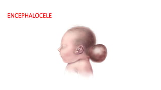 ENCEPHALOCELE
 