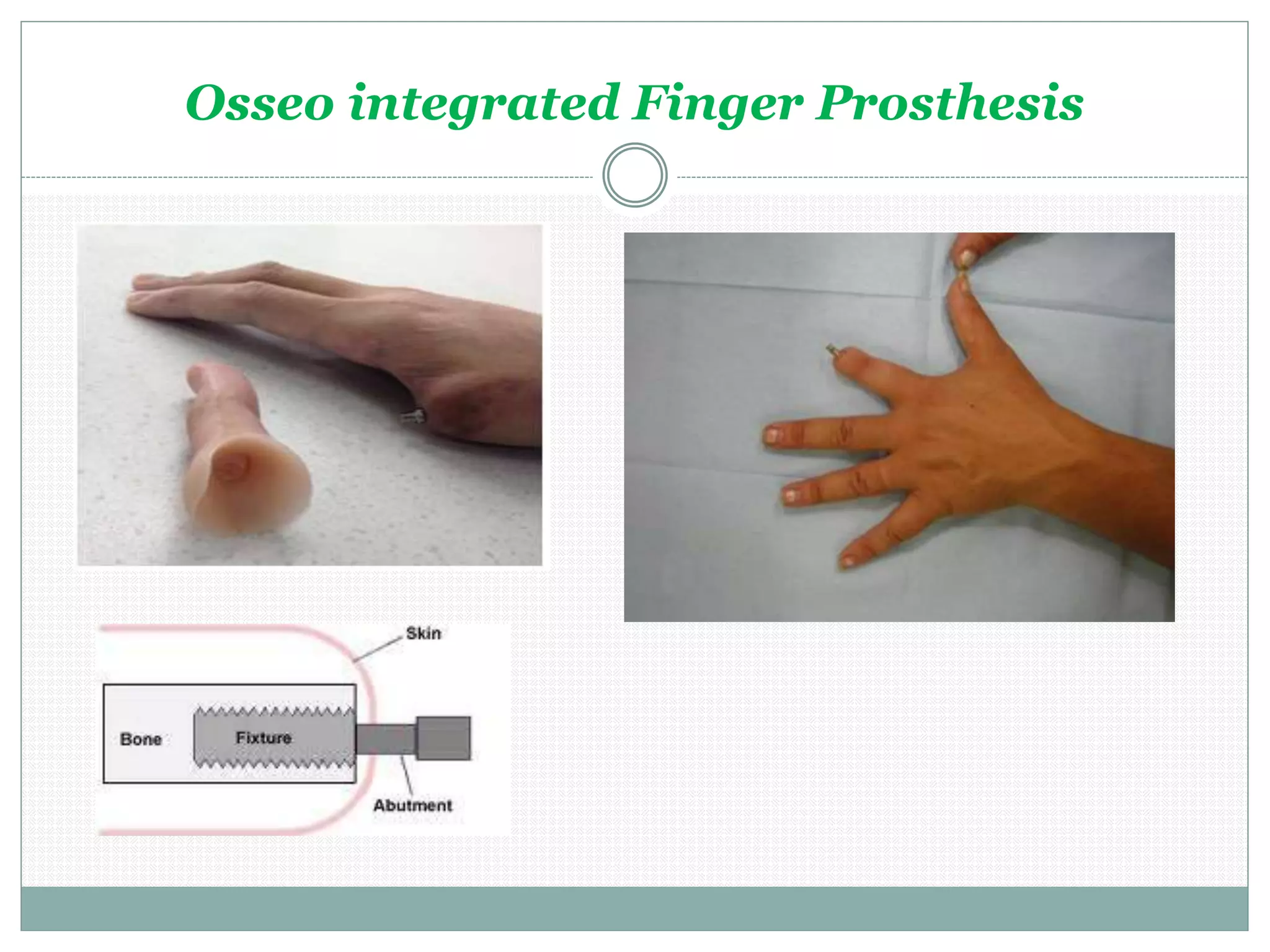 Osseo integrated Finger Prosthesis
 