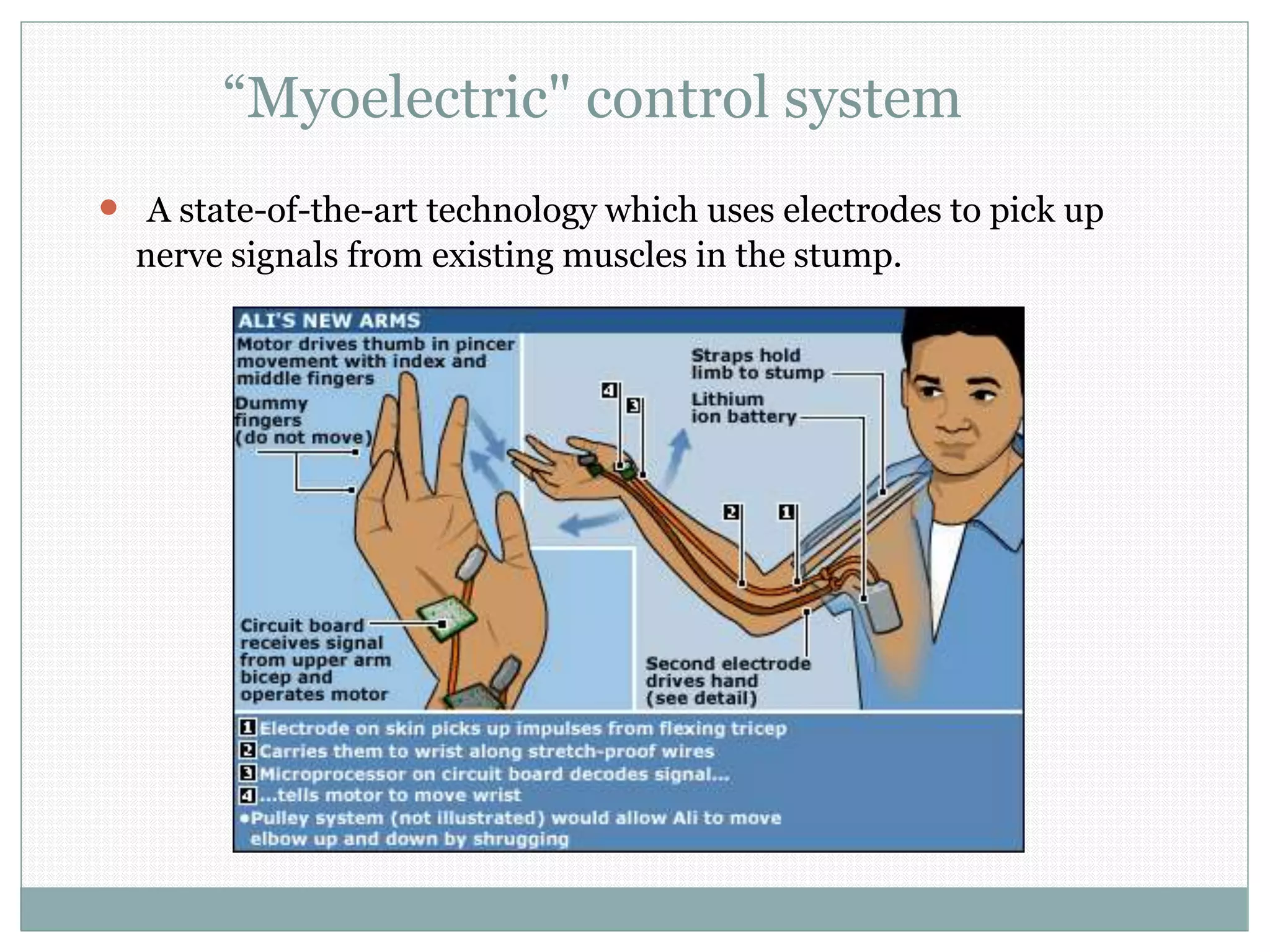 “Myoelectric" control system
 A state-of-the-art technology which uses electrodes to pick up
nerve signals from existing muscles in the stump.
 
