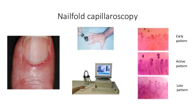 What is Raynaud's, what is scleroderma?