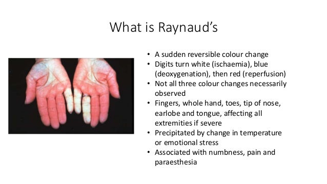 What is Raynaud's, what is scleroderma?