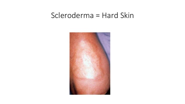 What is schleroderma?