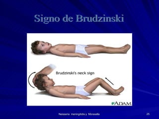 Signo de Brudzinski 
