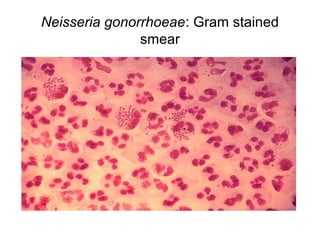 Neisseria gonorrhoeae: Gram stained
smear
 