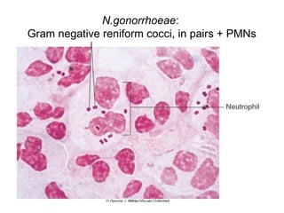 N.gonorrhoeae:
Gram negative reniform cocci, in pairs + PMNs
 