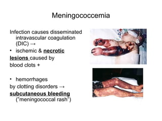 Meningococcemia
Infection causes disseminated
intravascular coagulation
(DIC) →
• ischemic & necrotic
lesions caused by
blood clots +
• hemorrhages
by clotting disorders →
subcutaneous bleeding
(”meningococcal rash”)
 