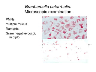 Branhamella catarrhalis:
- Microscopic examination -
PMNs,
multiple mucus
filaments,
Gram negative cocci,
in diplo
 