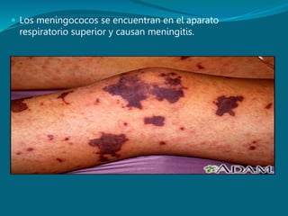  Los meningococos se encuentran en el aparato
respiratorio superior y causan meningitis.
 