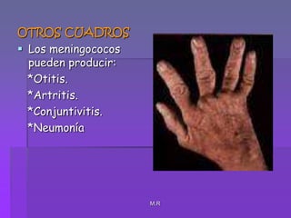 M.ROTROS CUADROSLos meningococos pueden producir:   *Otitis.   *Artritis.   *Conjuntivitis.   *Neumonía