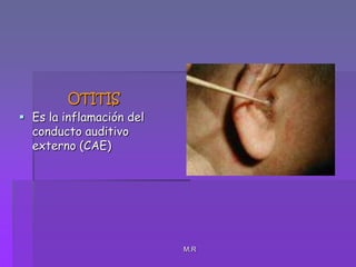 M.ROTITISEs la inflamación del conducto auditivo externo (CAE) 