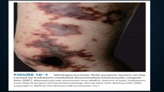 Nemaggitis Rash Neisseria Meningitidis Bacteria Microbiology Lecture | PPTX