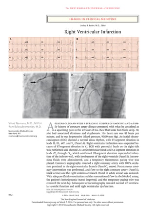 The new engl and jour nal of medicine
n engl j med 374;9 nejm.org March 3, 2016872
Images in Clinical Medicine
A
61-year-old man with a personal history of smoking and a fam-
ily history of coronary artery disease presented with what he described as
a squeezing pain in the left side of his chest that woke him from sleep. He
also had associated dizziness and diaphoresis. His heart rate was 85 beats per
minute, and he was hypotensive (blood pressure, 90/60 mm Hg). An initial electro-
cardiogram (ECG) showed a normal sinus rhythm, with ST-segment elevation in
leads II, III, aVF, and V1
(Panel A). Right ventricular infarction was suspected be-
cause of ST-segment elevation in V1
. ECG with precordial leads on the right side
was performed and showed 2:1 atrioventricular block and ST-segment elevation in
leads rV3
through rV6
, which confirmed ST-segment elevation myocardial infarc-
tion of the inferior wall, with involvement of the right ventricle (Panel B). Intrave-
nous fluids were administered, and a temporary transvenous pacing wire was
placed. Coronary angiography revealed a right coronary artery with 100% occlu-
sion proximal to the right ventricular branch (Panel C, arrow). Percutaneous coro-
nary intervention was performed, and flow to the right coronary artery (Panel D,
black arrow) and the right ventricular branch (Panel D, white arrow) was restored.
With adequate fluid resuscitation and the restoration of flow in the blocked artery,
the patient’s hemodynamic status improved, and the temporary pacing wire was
removed the next day. Subsequent echocardiography revealed normal left ventricu-
lar systolic function and mild right ventricular dysfunction.
DOI: 10.1056/NEJMicm1504379
Copyright © 2016 Massachusetts Medical Society.
Vinod Namana, M.D., M.P.H
Ram Balasubramanian, M.D.
Maimonides Medical Center
New York, NY
vnamana@maimonidesmed.org
A
I
II
II
III
aVR
aVL
aVF
V1
V2
V3
V4
V5
V6
I
II
III
aVR
aVL
aVF
rV1
rV2
rV3
rV4
rV5
rV6
B
C D
Lindsey R. Baden, M.D., Editor
Right Ventricular Infarction
The New England Journal of Medicine
Downloaded from nejm.org on March 2, 2016. For personal use only. No other uses without permission.
Copyright © 2016 Massachusetts Medical Society. All rights reserved.
 