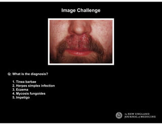 Image Challenge
What is the diagnosis?
1. Tinea barbae
2. Herpes simplex infection
3. Eczema
4. Mycosis fungoides
5. Impet...