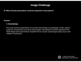 Answer:
Image Challenge
What clinical presentation would be expected in this patient?Q:
4. Quadriplegia
The most common pr...