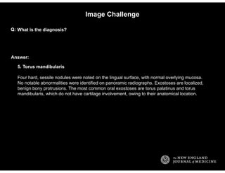 Answer:
Image Challenge
What is the diagnosis?Q:
5. Torus mandibularis
Four hard, sessile nodules were noted on the lingua...