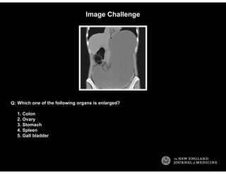 Image Challenge
Which one of the following organs is enlarged?
1. Colon
2. Ovary
3. Stomach
4. Spleen
5. Gall bladder
Q:
 