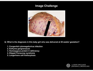 Image Challenge
What is the diagnosis in this baby girl who was delivered at 30 weeks' gestation?
1. Congenital cytomegalo...