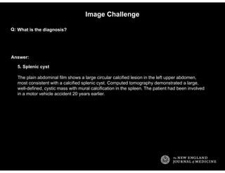Answer:
Image Challenge
What is the diagnosis?Q:
5. Splenic cyst
The plain abdominal film shows a large circular calcified...