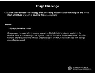 Answer:
Image Challenge
A woman underwent colonoscopy after presenting with colicky abdominal pain and loose
stool. What t...
