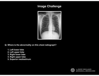 Image Challenge
Where is the abnormality on this chest radiograph?
1. Left lower lobe
2. Left upper lobe
3. Right lower lo...
