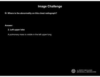 Answer:
Image Challenge
Where is the abnormality on this chest radiograph?Q:
2. Left upper lobe
A pulmonary mass is visibl...