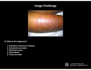 Image Challenge
What is the diagnosis?
1. Erythema chronicum migrans
2. Granuloma annulare
3. Pityriasis rosea
4. Sarcoido...