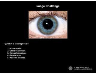 Image Challenge
What is the diagnosis?
1. Arcus senilis
2. Galactosialidosis
3. Hemochromatosis
4. Keratoconus
5. Wilson's...