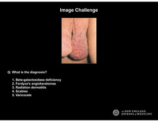 Image Challenge
What is the diagnosis?
1. Beta-galactosidase deficiency
2. Fordyce's angiokeratomas
3. Radiation dermatiti...