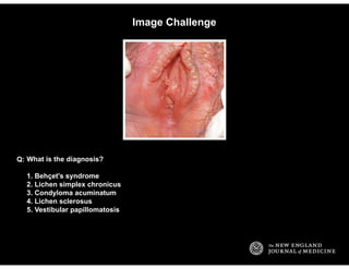 Image Challenge
What is the diagnosis?
1. Behçet's syndrome
2. Lichen simplex chronicus
3. Condyloma acuminatum
4. Lichen ...