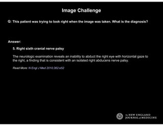 Answer:
Image Challenge
This patient was trying to look right when the image was taken. What is the diagnosis?Q:
5. Right ...