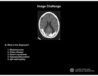 Image Challenge
What is the diagnosis?
1. Blastomycosis
2. Celiac disease
3. Down's syndrome
4. Hyperparathyroidism
5. IgA...