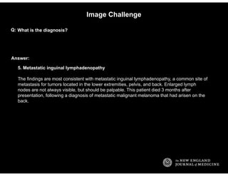 Answer:
Image Challenge
What is the diagnosis?Q:
5. Metastatic inguinal lymphadenopathy
The findings are most consistent w...