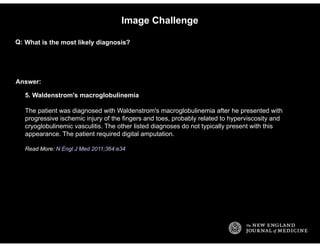 Answer:
Image Challenge
What is the most likely diagnosis?Q:
5. Waldenstrom's macroglobulinemia
The patient was diagnosed ...
