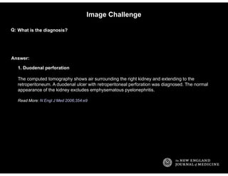 Answer:
Image Challenge
What is the diagnosis?Q:
1. Duodenal perforation
The computed tomography shows air surrounding the...