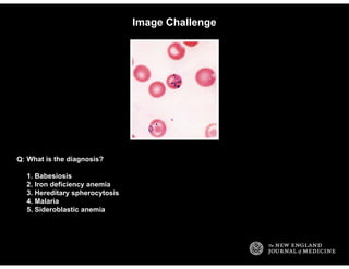 Image Challenge
What is the diagnosis?
1. Babesiosis
2. Iron deficiency anemia
3. Hereditary spherocytosis
4. Malaria
5. S...