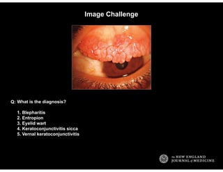 Image Challenge
What is the diagnosis?
1. Blepharitis
2. Entropion
3. Eyelid wart
4. Keratoconjunctivitis sicca
5. Vernal ...