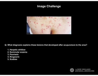 Image Challenge
What diagnosis explains these lesions that developed after acupuncture to the area?
1. Herpetic whitlow
2....